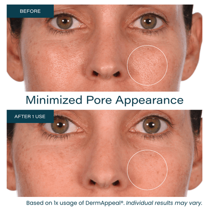DermAppeal® Microdermabrasion Treatment - Limited Time Offer