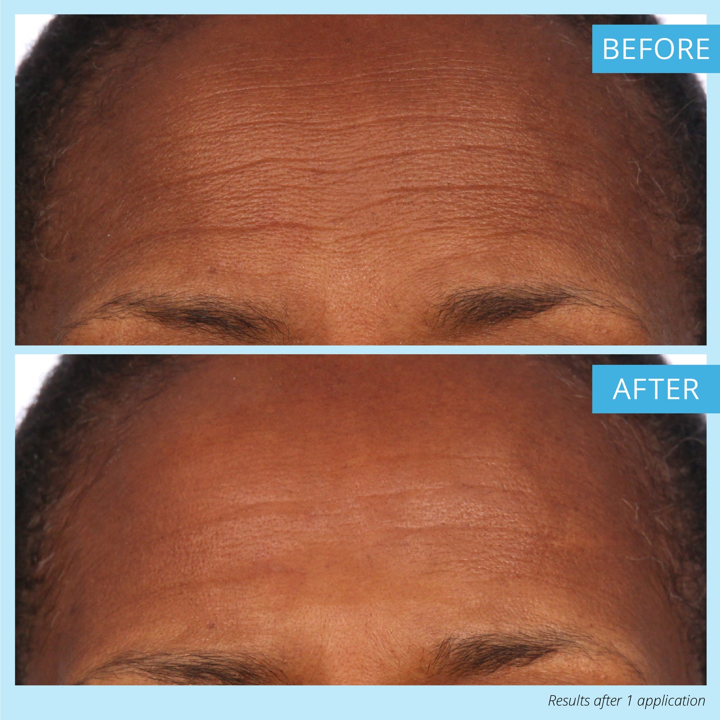 Dermappeal® - At-Home Microdermabrasion Treatment - 40% OFF