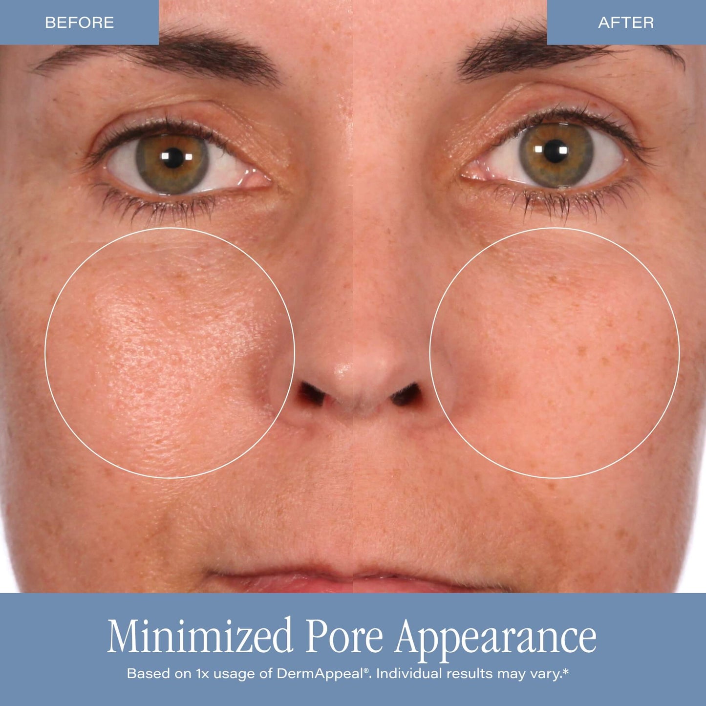 SKINN Cosmetics DermAppeal Microdermabrasion Treatment w/ V5 Crystal Technology Facial Exfoliate Tube - Powerful Microdermabrasion Treatment for All Skin Types