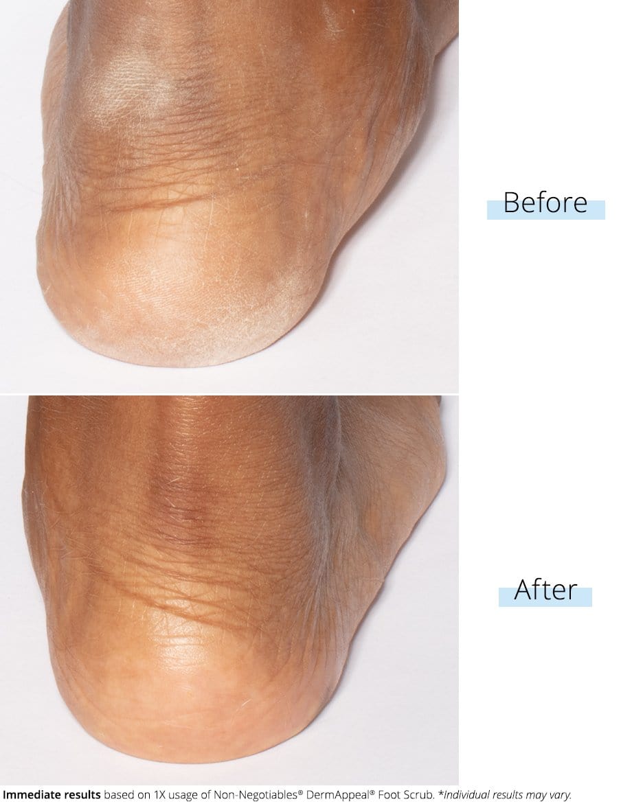 SKINN DermAppeal® Foot Scrub