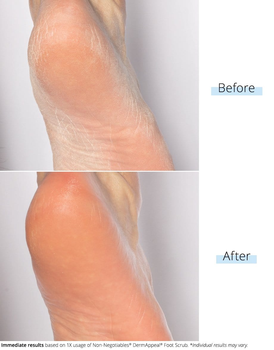 SKINN DermAppeal® Foot Scrub