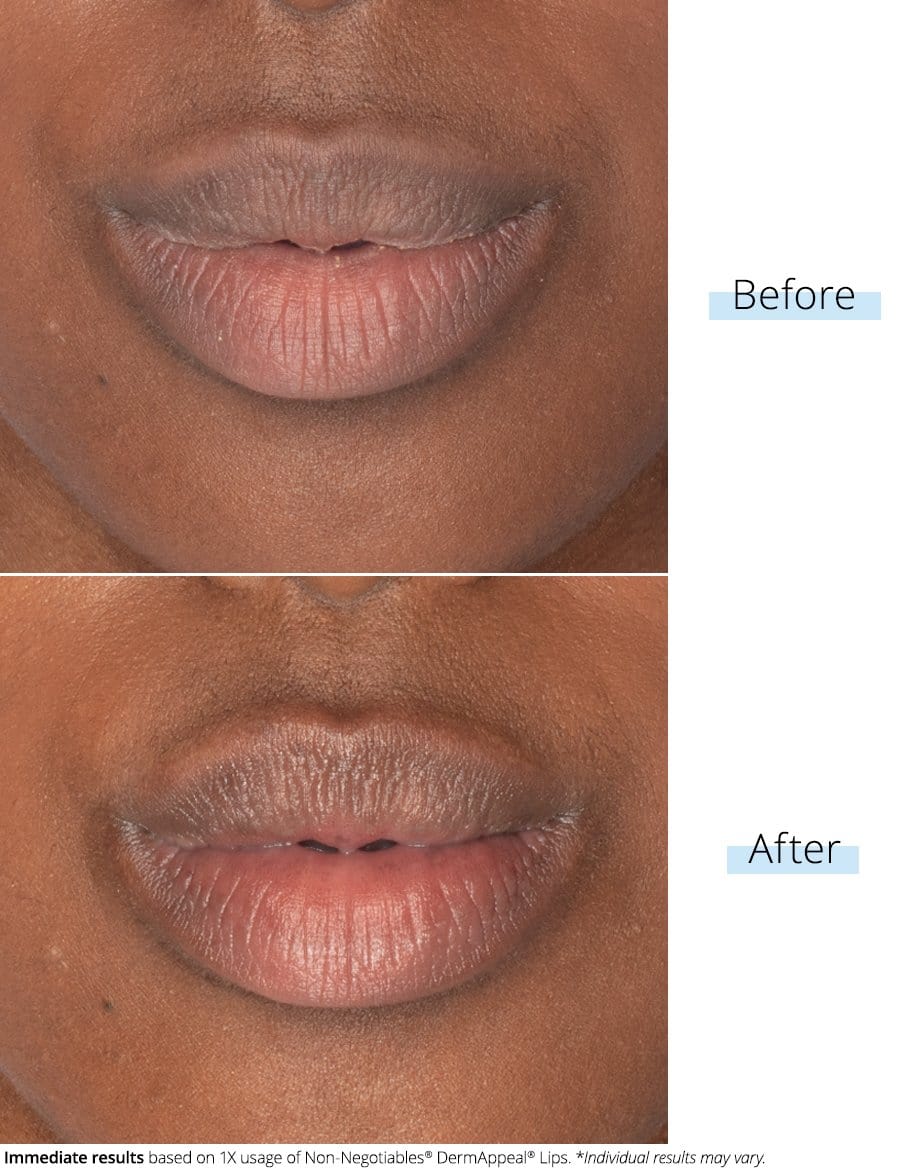 SKINN DermAppeal® Lips