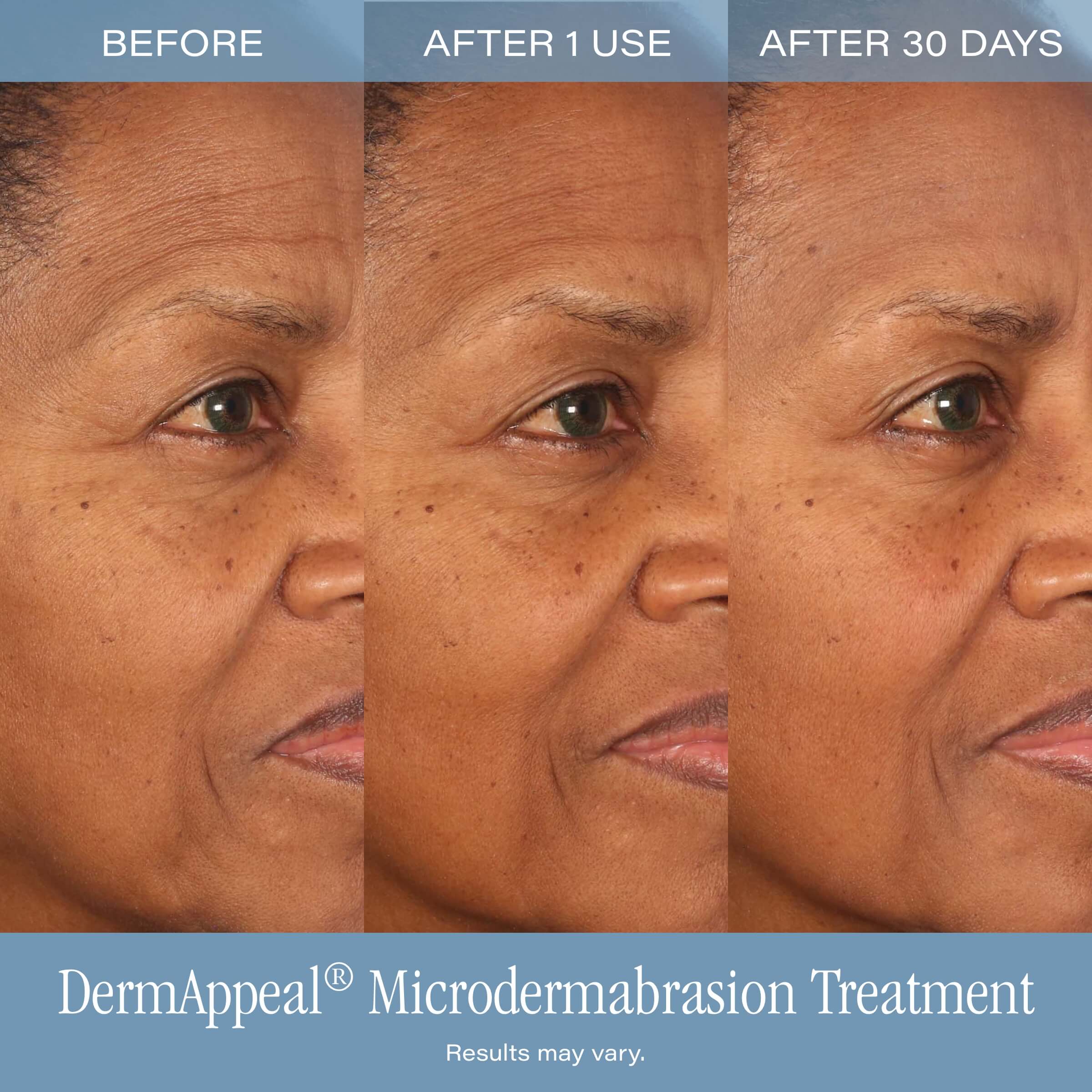 SKINN | DermAppeal | Vitamin C Microdermabrasion Treatment