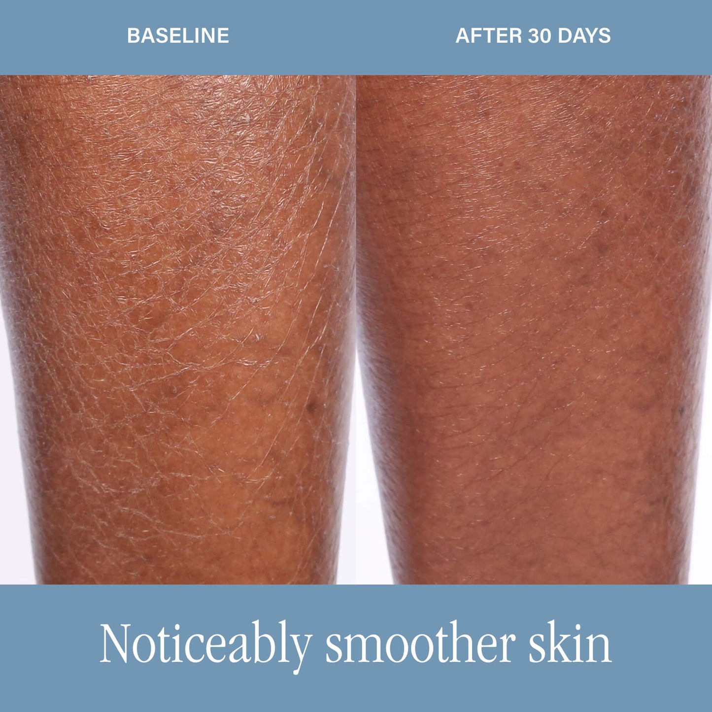 SKINN DermAppeal® Body