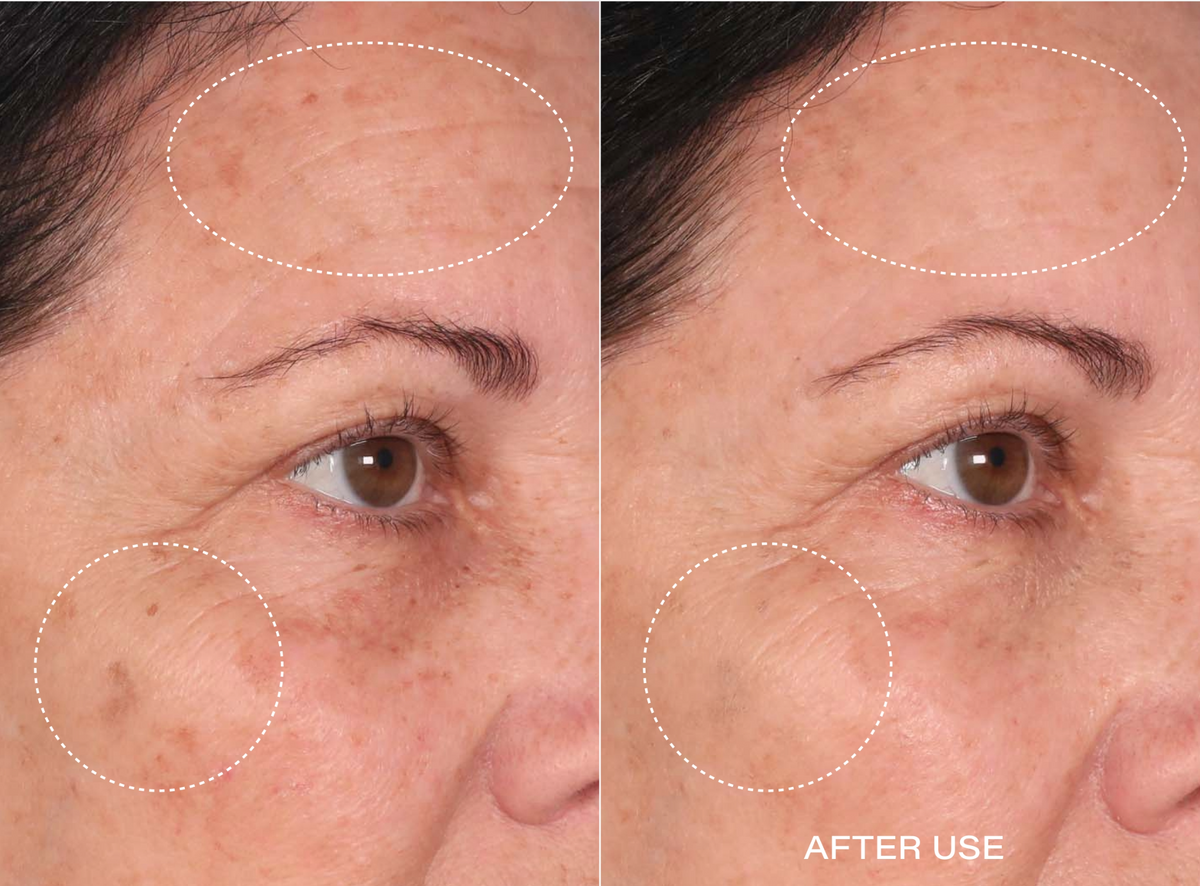Before and after result